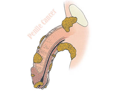 Penile-cancer