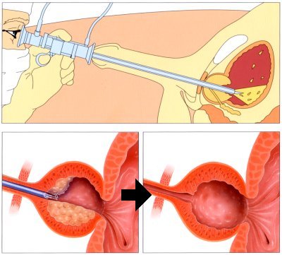 TURP-surgery1