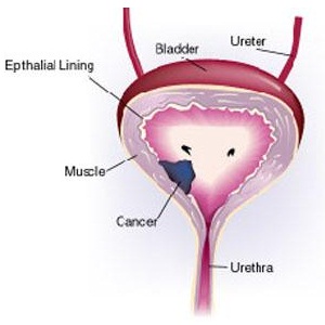 bladder-cancer