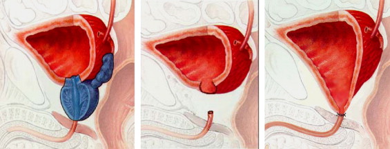 radicale_prostatectomie