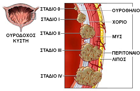 stage-bladder-cancer