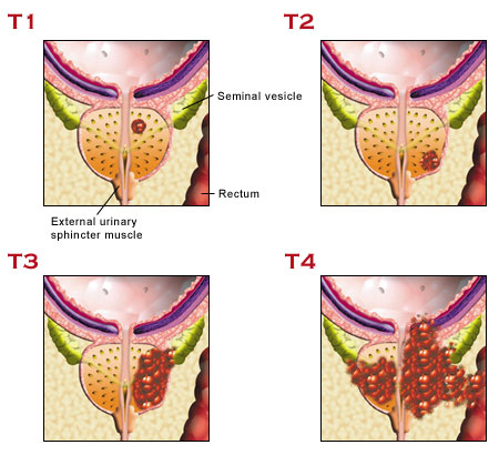 stages-of-prostate-cancer